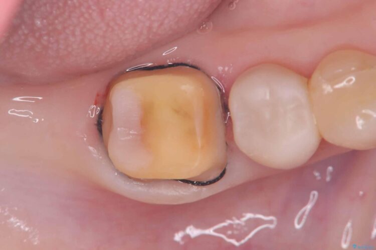 破折したセラミックインレーのやり替え 治療途中画像