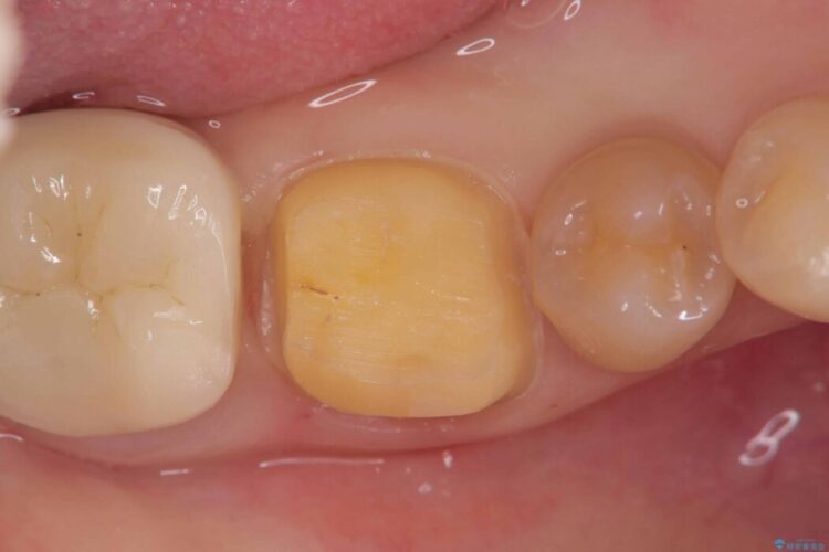 長期的な安定性を重視したセラミック治療 治療途中画像