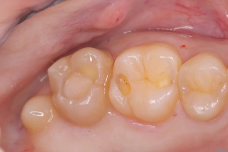 詰め物の下の見えない虫歯 治療途中画像