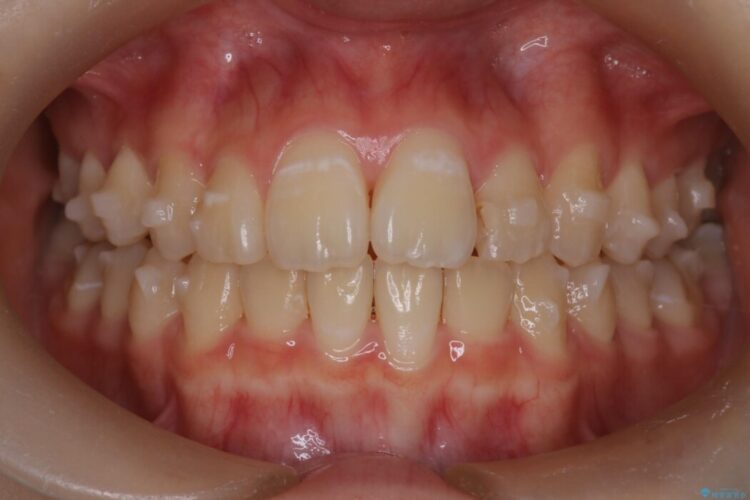 インビザラインで前歯のガタつきを改善 治療途中画像