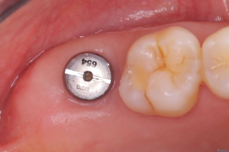 切らない・腫れにくい短期間治療【1DAYインプラント】 治療途中画像