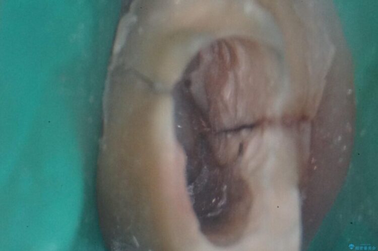 歯根破折した歯のインプラント治療 治療途中画像