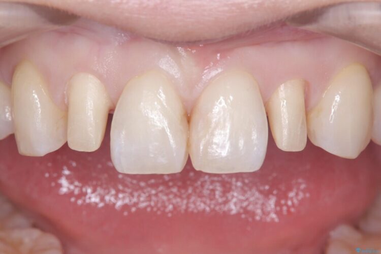 矮小歯と変色した詰め物をオールセラミッククラウンで修復 治療途中画像