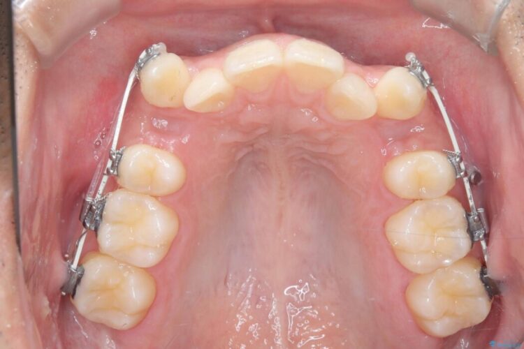 ワイヤー抜歯矯正治療で 治療途中画像