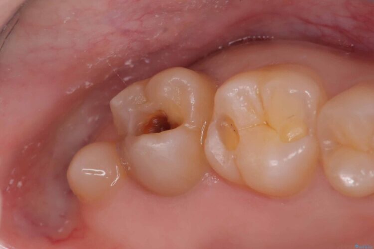 詰め物の下の見えない虫歯 治療途中画像