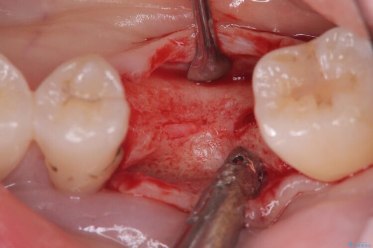 長期間の放置で骨が吸収した部位のインプラント治療 治療途中画像