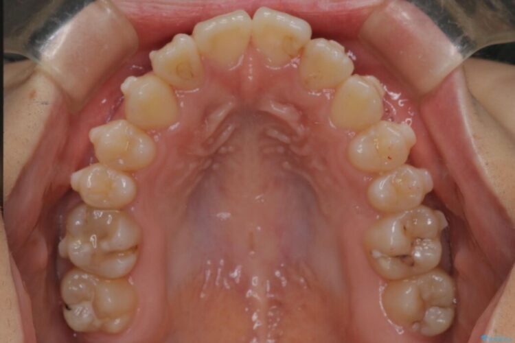 インビザラインで前歯のガタつきを改善 治療途中画像