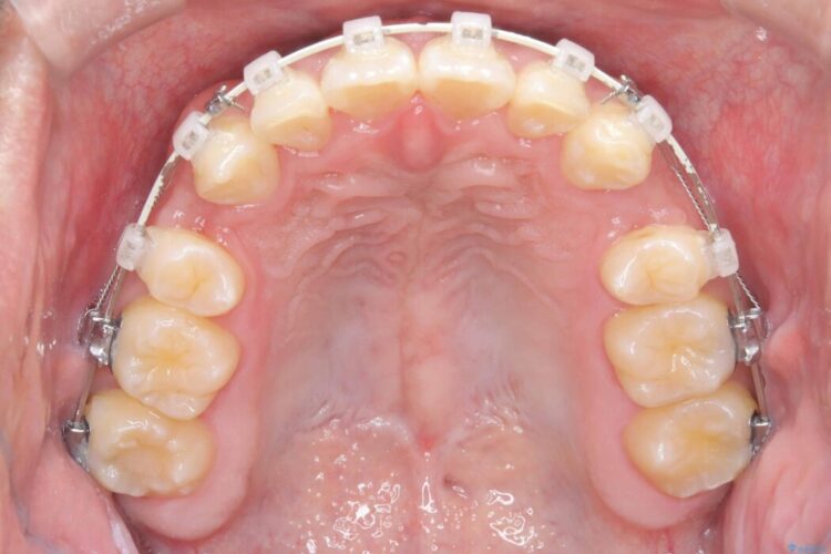 歯のガタつきと口元の突出感の改善 治療途中画像