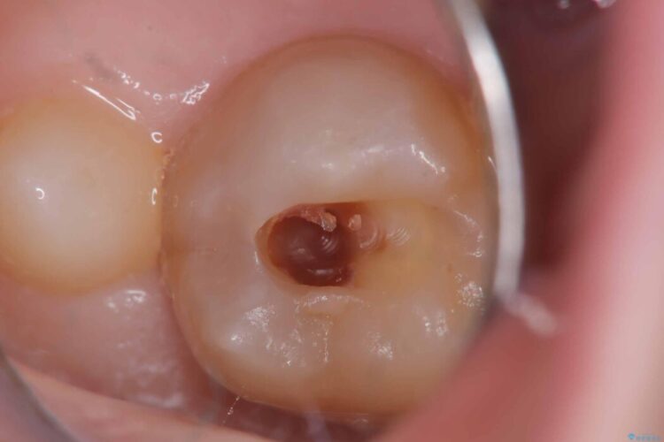 詰め物の下の見えない虫歯 治療途中画像