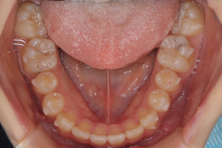 インビザラインで前歯のガタつきを改善 治療途中画像