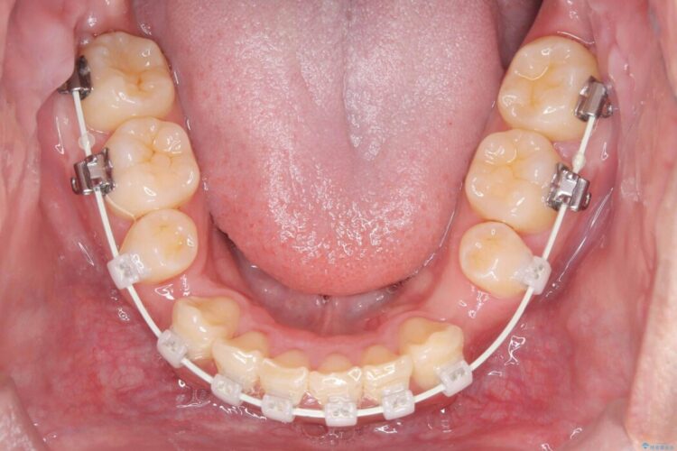 歯のガタつきと口元の突出感の改善 治療途中画像