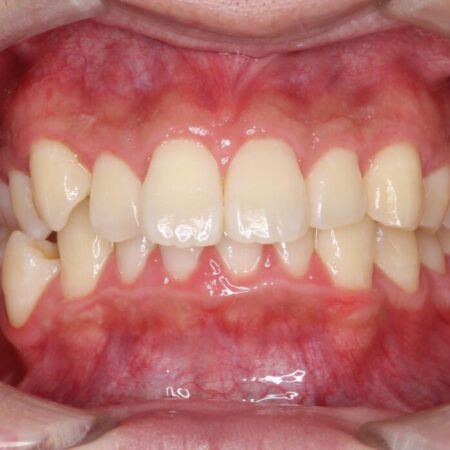 歯のガタつきと口元の突出感の改善 治療前