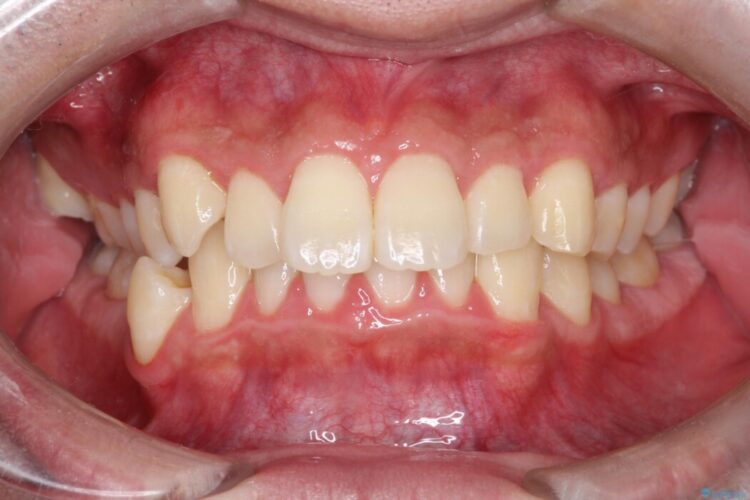 歯のガタつきと口元の突出感の改善 治療前画像