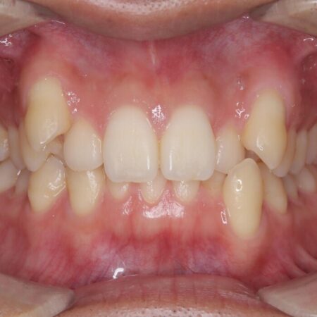 ワイヤー抜歯矯正治療で 治療前