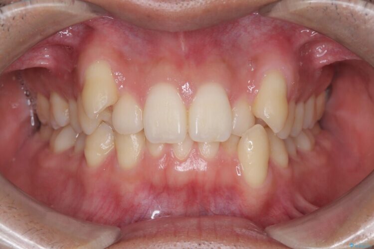 ワイヤー抜歯矯正治療で 治療前画像