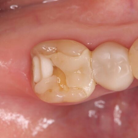 破折したセラミックインレーのやり替え 治療前