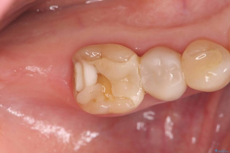 破折したセラミックインレーのやり替え ビフォー