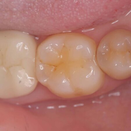 長期的な安定性を重視したセラミック治療 治療前