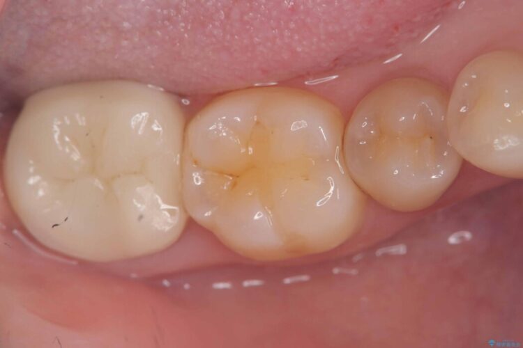長期的な安定性を重視したセラミック治療 ビフォー