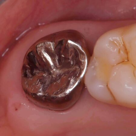 切らない・腫れにくい短期間治療【1DAYインプラント】 治療前