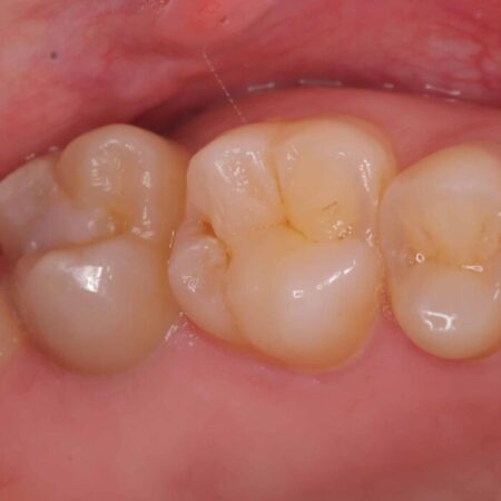 詰め物の下の見えない虫歯 治療前