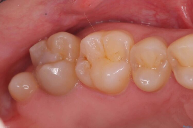 詰め物の下の見えない虫歯 ビフォー