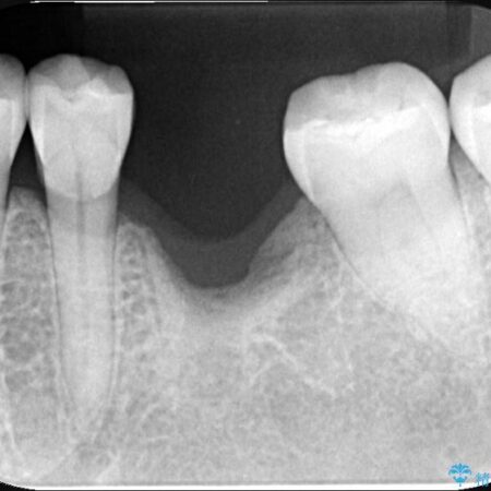 長期間の放置で骨が吸収した部位のインプラント治療 治療前