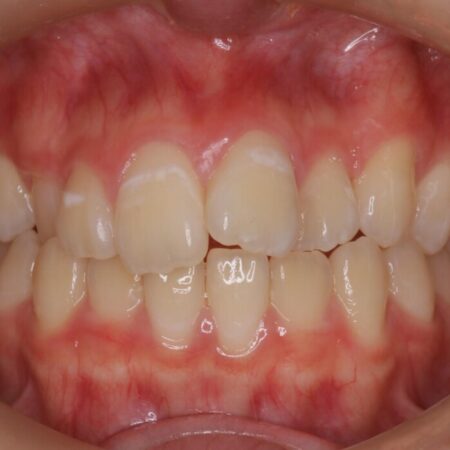 インビザラインで前歯のガタつきを改善 治療前