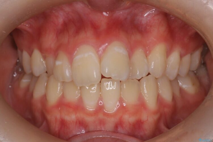 インビザラインで前歯のガタつきを改善 治療前画像