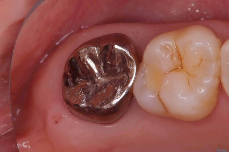 切らない・腫れにくい短期間治療【1DAYインプラント】 治療前画像