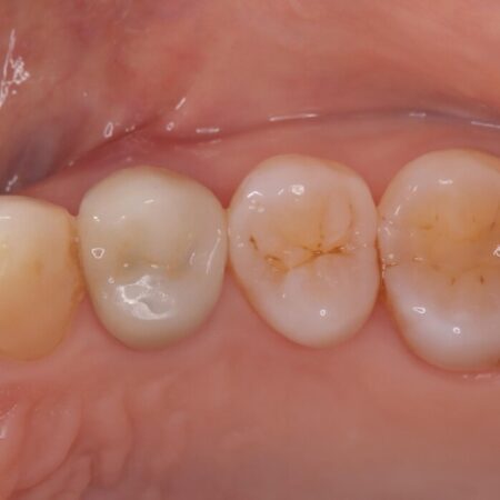 歯根破折した歯のインプラント治療 治療前