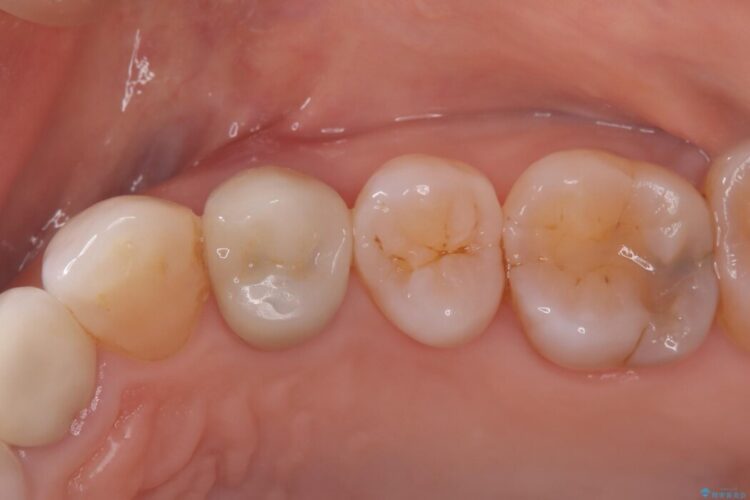 歯根破折した歯のインプラント治療 ビフォー