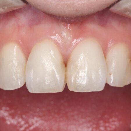 矮小歯と変色した詰め物をオールセラミッククラウンで修復 治療前