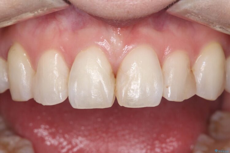 矮小歯と変色した詰め物をオールセラミッククラウンで修復 ビフォー