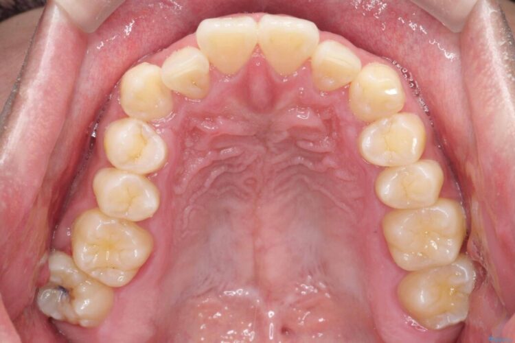 歯のガタつきと口元の突出感の改善 治療前画像