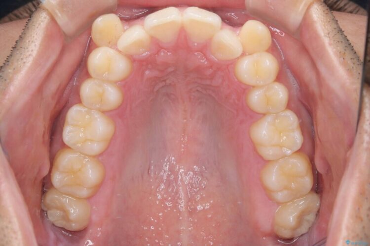 ワイヤー抜歯矯正治療で 治療前画像