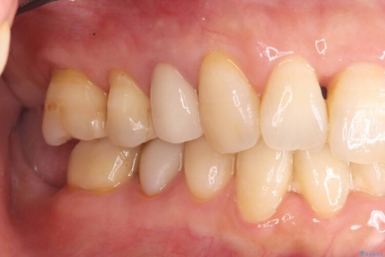 破折したセラミックインレーのやり替え 治療前画像