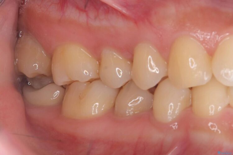長期的な安定性を重視したセラミック治療 治療前画像