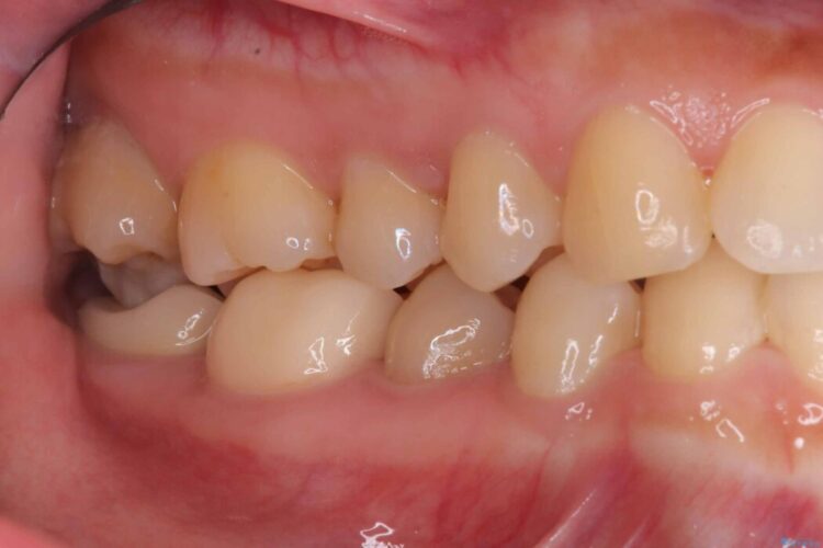 詰め物の下の見えない虫歯 治療前画像