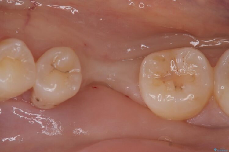 長期間の放置で骨が吸収した部位のインプラント治療 治療前画像