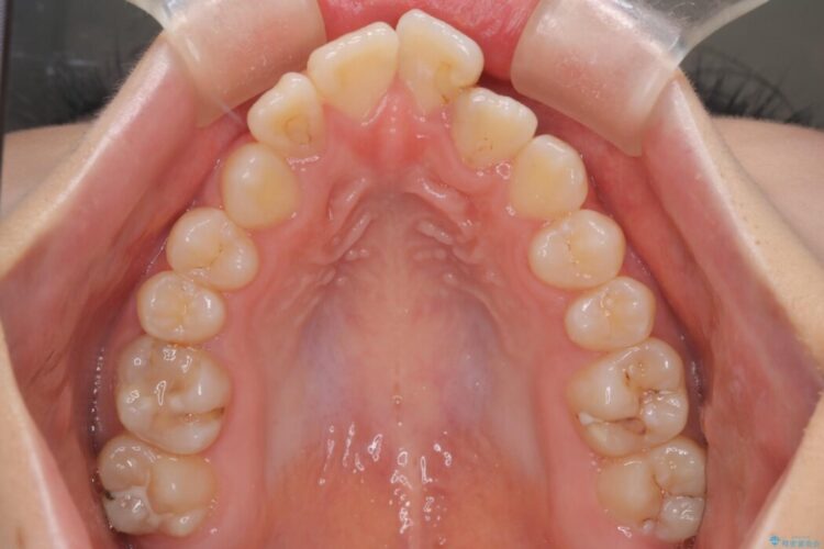 インビザラインで前歯のガタつきを改善 治療前画像