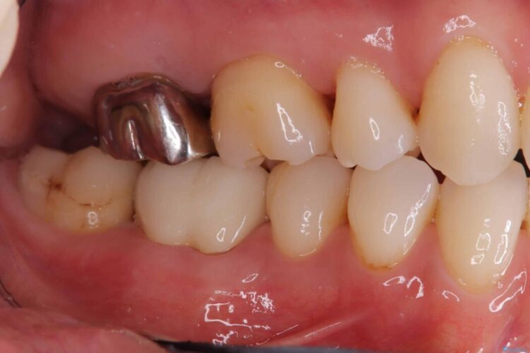 切らない・腫れにくい短期間治療【1DAYインプラント】 治療前画像