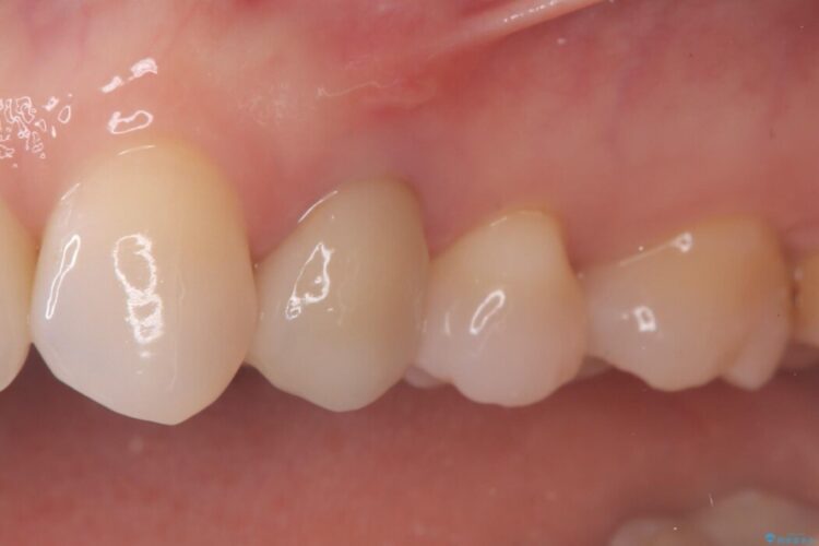 歯根破折した歯のインプラント治療 治療前画像