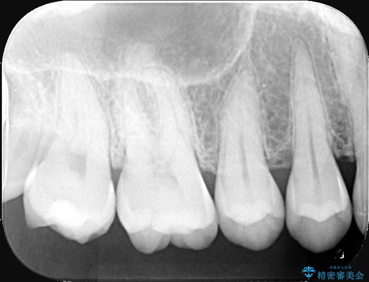 詰め物の下の見えない虫歯 治療前画像