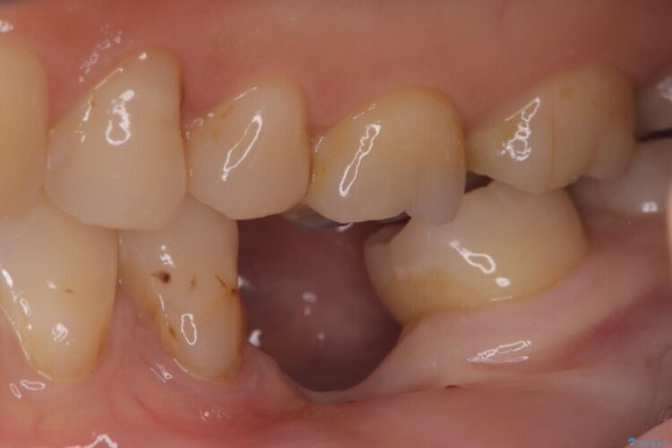 長期間の放置で骨が吸収した部位のインプラント治療 治療前画像