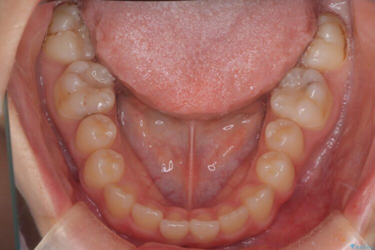 インビザラインで前歯のガタつきを改善 治療前画像