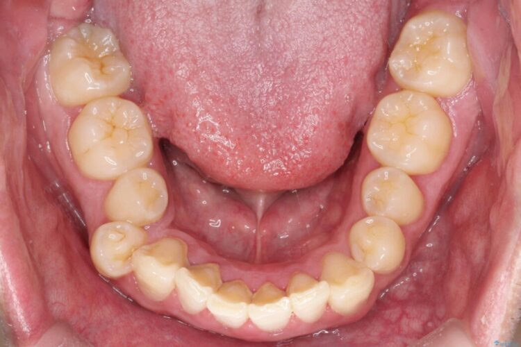 歯のガタつきと口元の突出感の改善 治療前画像