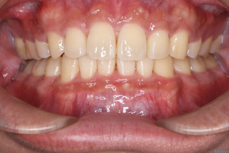 歯のガタつきと口元の突出感の改善 治療後画像