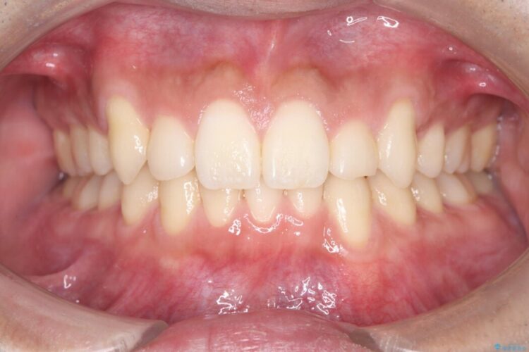 ワイヤー抜歯矯正治療で 治療後画像