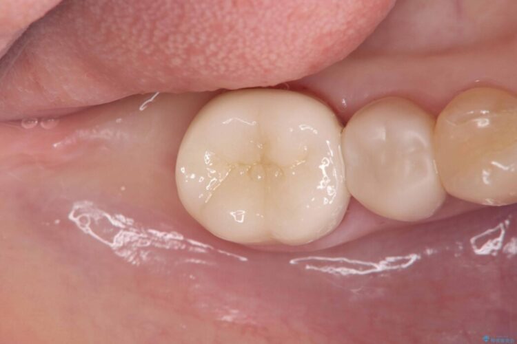 破折したセラミックインレーのやり替え アフター